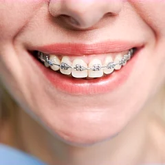Sorriso com aparelho dentário fixo, de perto