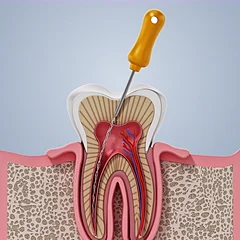 Ilustração 3D do dente em corte, com a lima limpando o canal